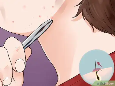 Imagen titulada Remove Ingrown Hair on Your Face Step 2