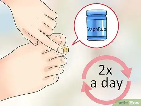 Imagen titulada Get Rid of Foot Fungus at Home Step 1