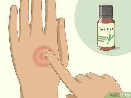 Imagen titulada Get Rid of Ringworm Naturally Step 1