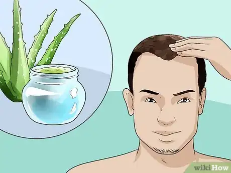 Imagen titulada Treat Male Pattern Hair Loss Step 12