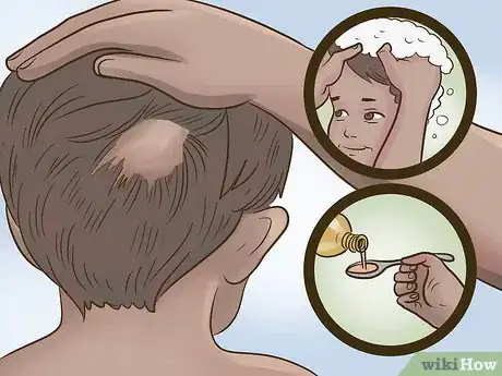 Imagen titulada Stop Hair Loss in Children Step 8