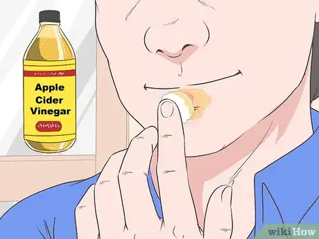 Imagen titulada Treat a Cold Sore or Fever Blisters Step 18