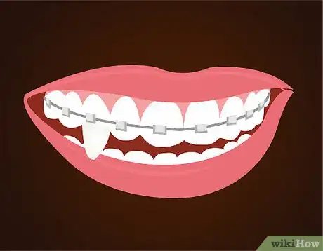Imagen titulada Make Vampire Fangs if You Have Braces Step 5