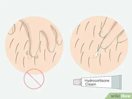 Imagen titulada Get Rid of Ingrown Pubic Hair Step 3