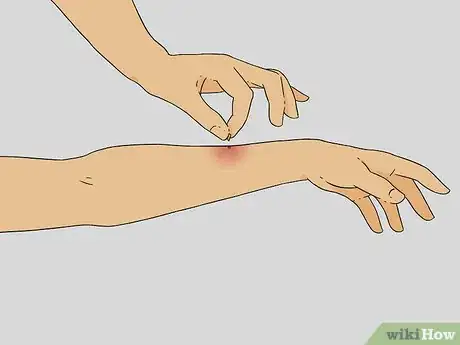 Imagen titulada Treat a Bee Sting Step 1