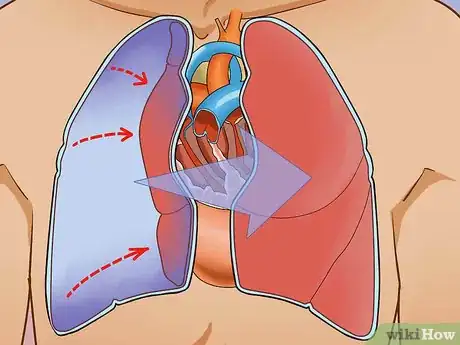 Imagen titulada Treat Obstructive Shock Step 2