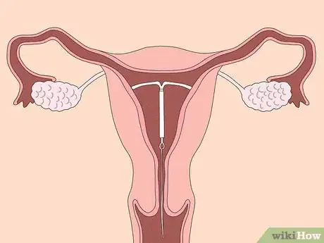 Imagen titulada Shorten Your Period Step 2