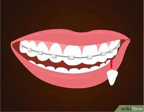 Imagen titulada Make Vampire Fangs if You Have Braces Step 7