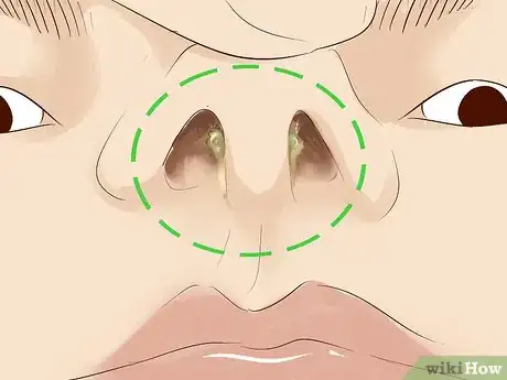 Imagen titulada Get a Septum (Nose Cartilage Wall) Piercing Step 16.jpeg