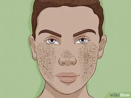 Imagen titulada Close Blackhead Holes Step 2