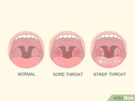 Imagen titulada Tell if You Have Strep Throat Step 1