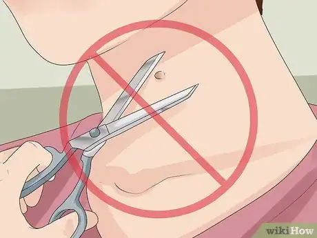 Imagen titulada Get Rid of Skin Tags Step 21