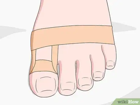 Imagen titulada Stop a Bunion from Growing Step 9