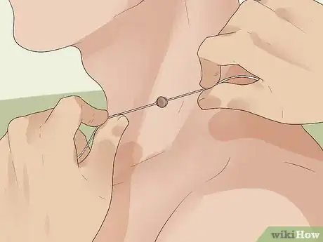 Imagen titulada Get Rid of Skin Tags Step 20