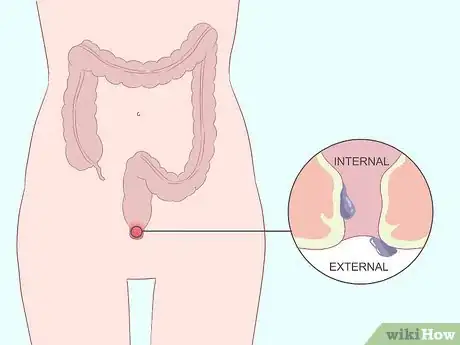 Imagen titulada Get Rid of Hemorrhoids Fast Step 1