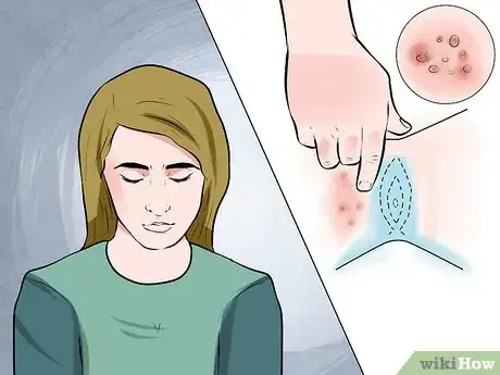 Imagen titulada Recognize Genital Warts Step 1