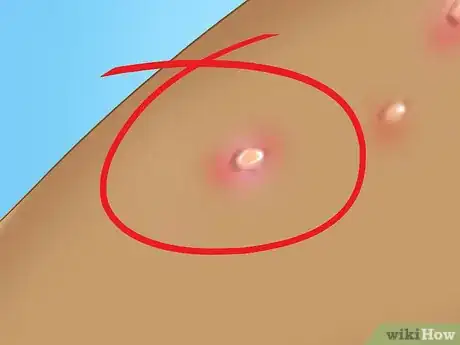 Imagen titulada Recognize Molluscum (Molluscum Contagiosum) Step 4