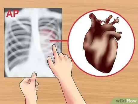Imagen titulada Read a Chest X Ray Step 9