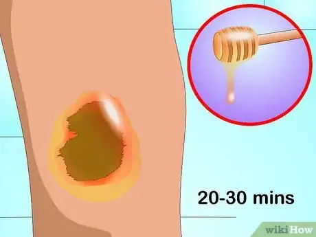 Imagen titulada Get Rid of Acne Scabs Fast Step 14