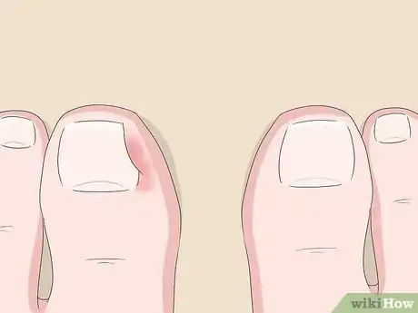 Imagen titulada Relieve Ingrown Toe Nail Pain Step 1
