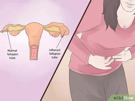 Imagen titulada Treat Blocked Fallopian Tubes Step 9