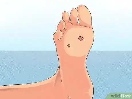 Imagen titulada Get Rid of Plantar Warts (Verrucas) Step 12