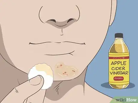 Imagen titulada Get Rid of a Blind Pimple Step 2