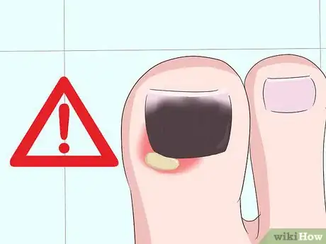 Imagen titulada Treat a Black Toenail Step 5