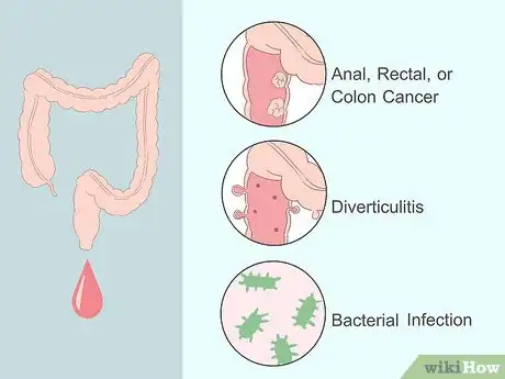 Imagen titulada Get Rid of Hemorrhoids Fast Step 3