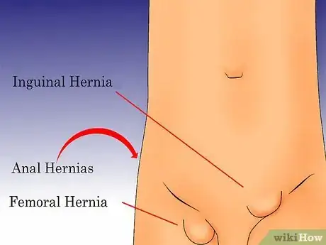 Imagen titulada Check for a Hernia Step 2