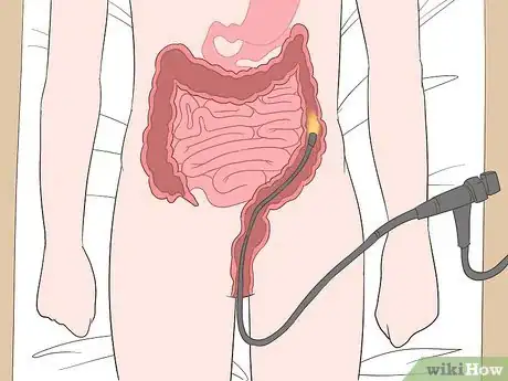 Imagen titulada Recognize Colon Cancer Symptoms Step 8