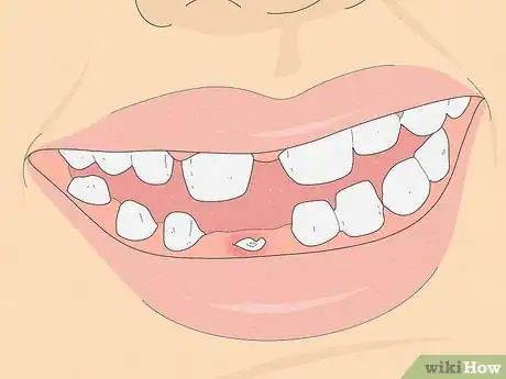 Imagen titulada Pull a Loose Tooth at Home Step 14