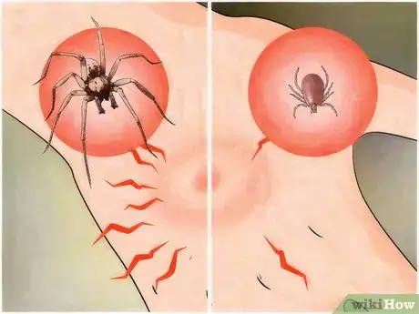 Imagen titulada Identify a Spider Bite Step 7