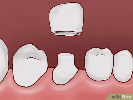 Imagen titulada Treat a Broken Tooth Step 13