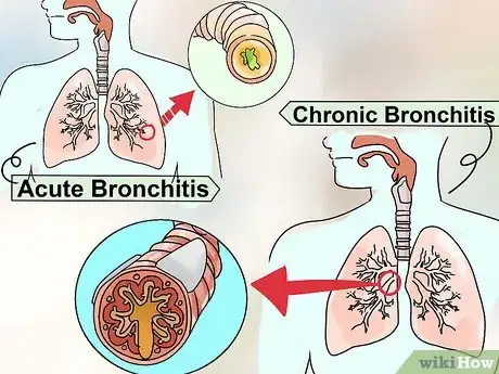 Imagen titulada Prevent Bronchitis Step 11