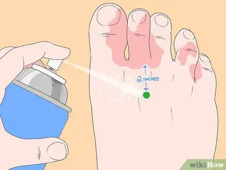 Imagen titulada Stop Itching Caused by Athlete's Foot Step 3