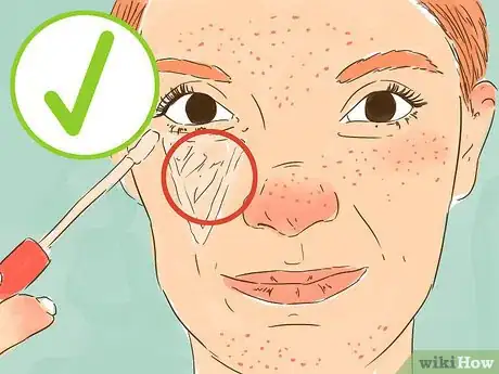 Imagen titulada Be Confident If You Have Acne Step 14