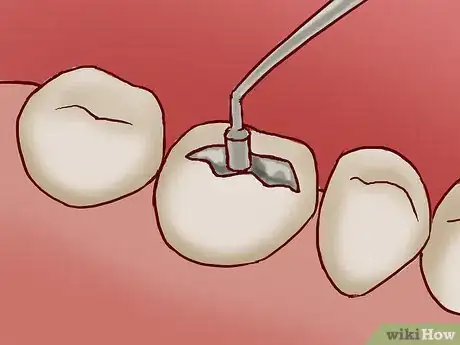 Imagen titulada Treat a Broken Tooth Step 12