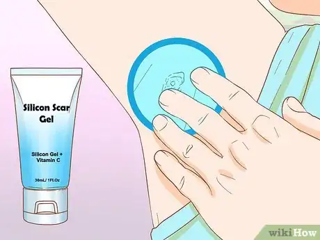 Imagen titulada Get Rid of Boil Scars Step 2