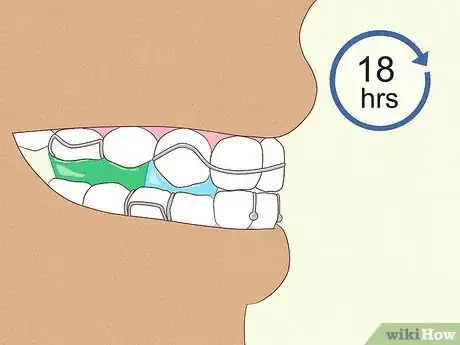 Imagen titulada Cope with Twin Block Braces Step 9