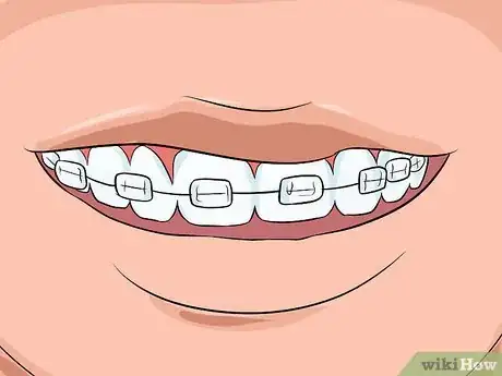 Imagen titulada Choose the Color of Your Braces Step 11