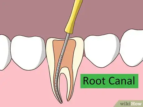 Imagen titulada Treat Cavities Step 6