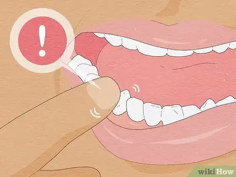 Imagen titulada Pull a Loose Tooth at Home Step 18