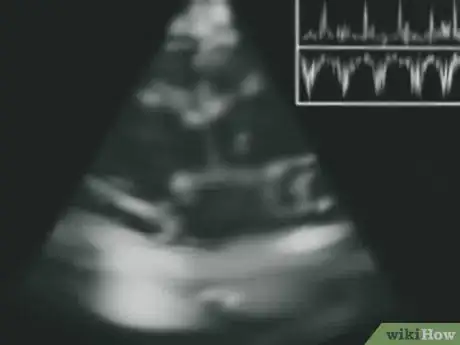 Imagen titulada Determine Cardiac Output Step 9