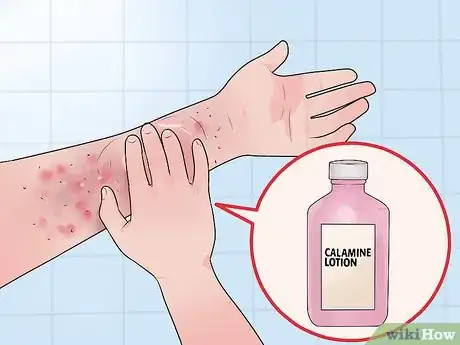 Imagen titulada Get Rid of Stress Hives Step 10