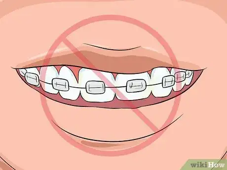 Imagen titulada Choose the Color of Your Braces Step 13