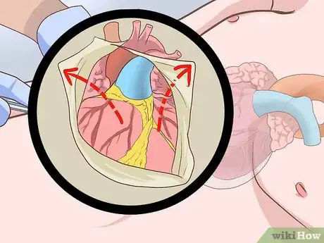 Imagen titulada Treat Obstructive Shock Step 9