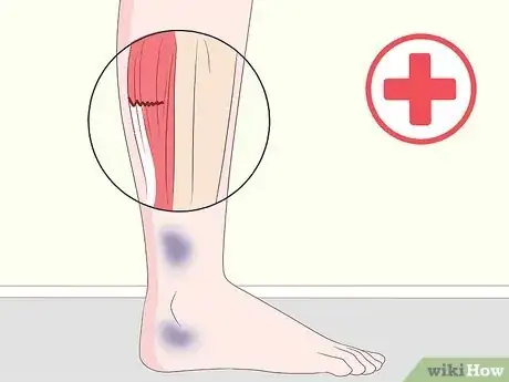 Imagen titulada Get Rid of Leg Pain Step 13