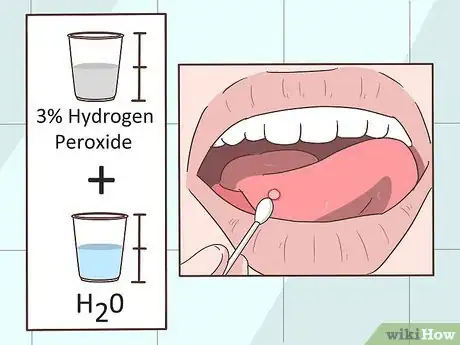 Imagen titulada Remove a Mouth Ulcer Step 5