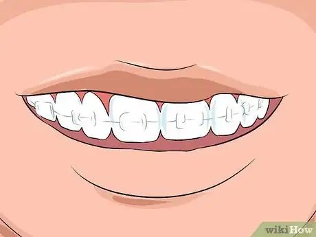 Imagen titulada Choose the Color of Your Braces Step 12